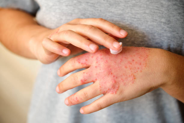 Eczema